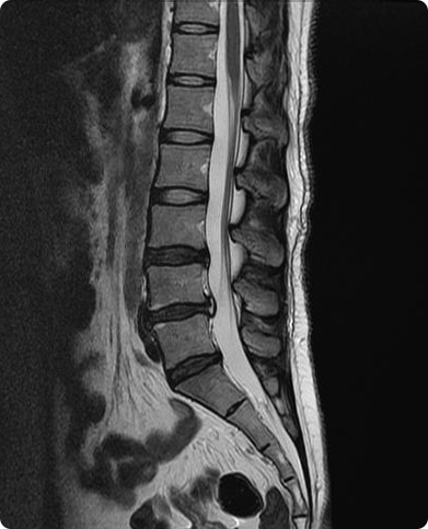 양방향 척추내시경수술(UBE) 수술 후 : 감압된 척추관 MRI