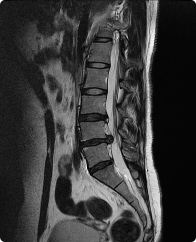 척추 유합술 및 감압술 수술 전 : 협착 또는 전방전위가 확인되는 MRI