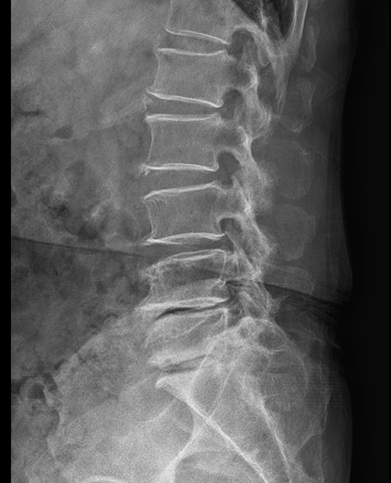 척추 유합술 및 감압술 수술 전 : 협착 또는 전방전위가 확인되는 MRI