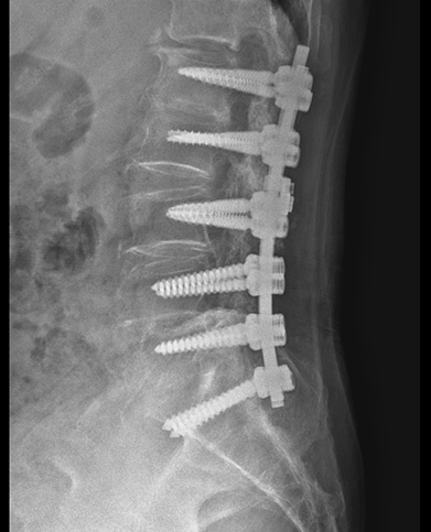 척추 유합술 및 감압술 수술 후 : 금속 나사와 케이지가 삽입된 X-RAY