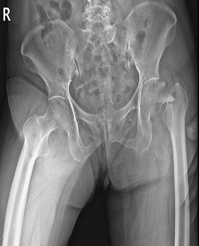 관절 간격 감소 또는 대퇴골두 변형이 확인되는 X-ray