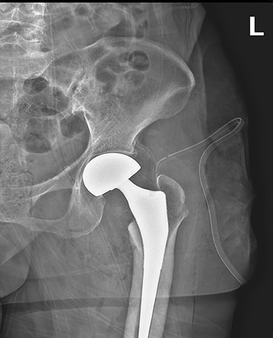 인공고관절이 안정적으로 삽입된 X-ray