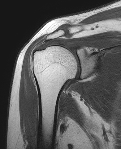회전근개파열 봉합술 수술 전 : 회전근개 파열이 확인되는 MRI