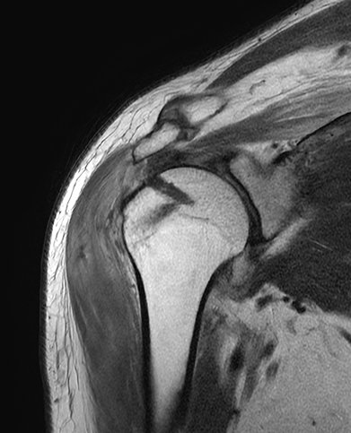 회전근개파열 봉합술 수술 후 : 봉합 앵커가 삽입된 어깨 X-RAY