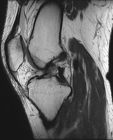 전방십자인대 재건술 수술 전 : 전방십자인대 파열이 확인되는 MRI