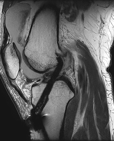 전방십자인대 재건술 수술 후 : 골 터널과 고정장치가 확인되는 X-RAY