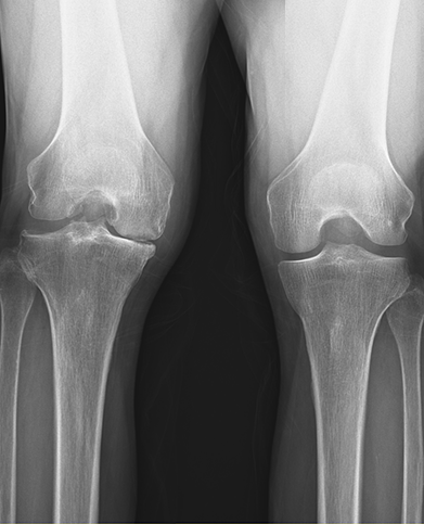 무릎인공관절치환술 수술 전 : 관절 간격 감소와 변형이 확인되는 X-RAY