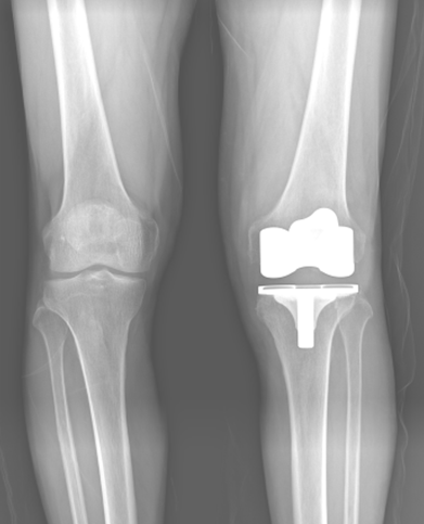 무릎인공관절치환술 수술 후 : 인공관절이 정확한 위치에 삽입된 X-RAY